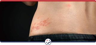 Shingles Treatment Doctor Near Me in Parrish, Bradenton, Sarasota, Lithia, Lehigh Acres, Estero, Port Charlotte, West Bradenton and Ellenton, FL