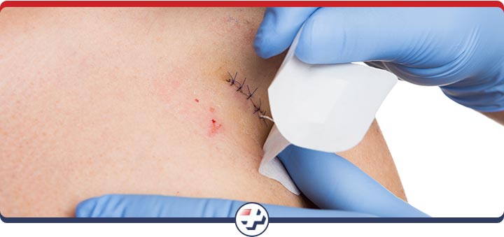 Laceration Repair Procedure Clinic Near Me in Parrish, Bradenton, Sarasota, Lithia, Lehigh Acres, Estero, Port Charlotte, West Bradenton and Ellenton FL