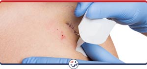 Laceration Repair Procedure Clinic Near Me in Parrish, Bradenton, Sarasota, Lithia, Lehigh Acres, Estero, Port Charlotte, West Bradenton and Ellenton FL